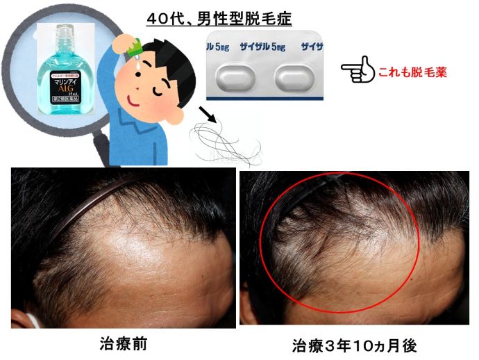円形脱毛症　病院